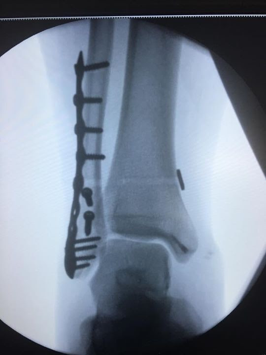 Fractura de tobillo